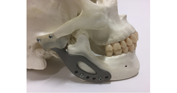 Personalised 3D printed prosthesis of temporomandibular joint, 2017. Dr David Ackland led an interdisciplinary team in Biomedical Engineering and St Vincent’s Hospital.